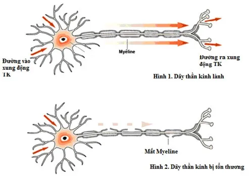Trong bệnh lý này, hệ thống miễn dịch trực tiếp chống lại các dây thần kinh ngoại biên, thường nhất là dây thần kinh có bao myelin.