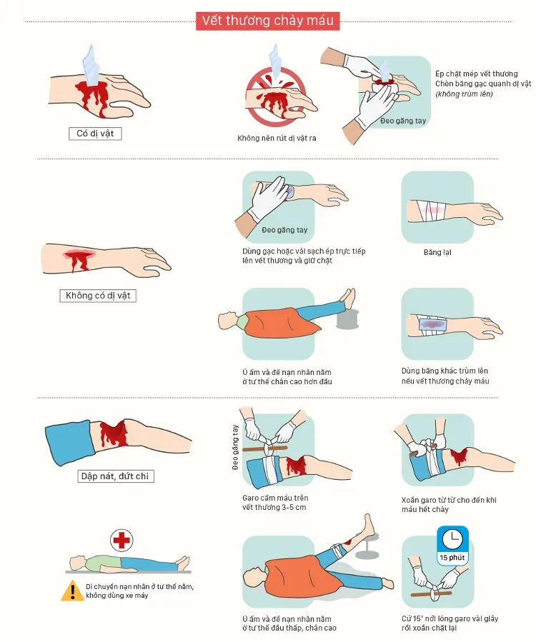 Đối với vết thương hở không có dị vật, bạn dùng gạc hoặc vải sạch ép trực tiếp lên vết thương và giữ chặt.