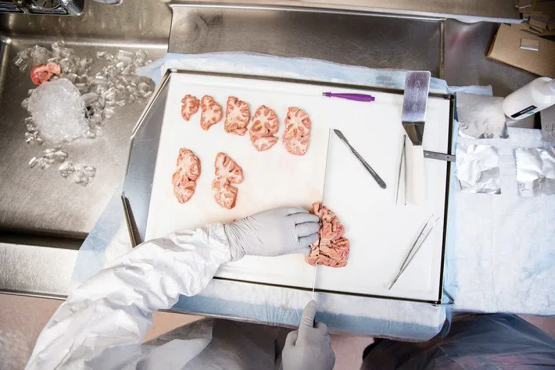 Thời gian trung bình để vận chuyển bộ não tới trung tâm ở bệnh viện McLean Hospital, Massachusetts, Mỹ là 17 tiếng.