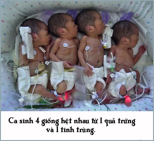 Ca sinh 4 cùng trứng giống hệt nhau