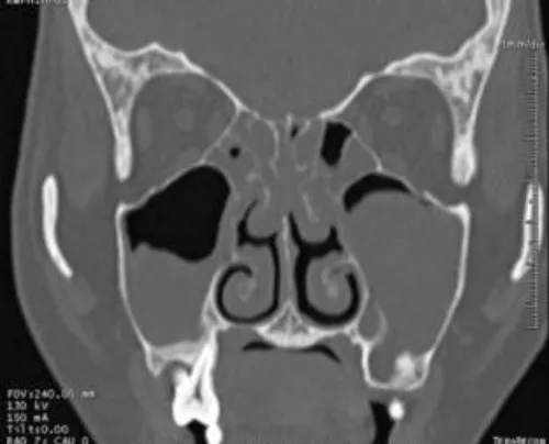 CT scan mũi xoang.