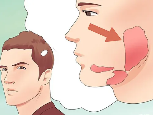 Cách phòng ngừa quai bị hiệu quả nhất là tiêm vắc xin.