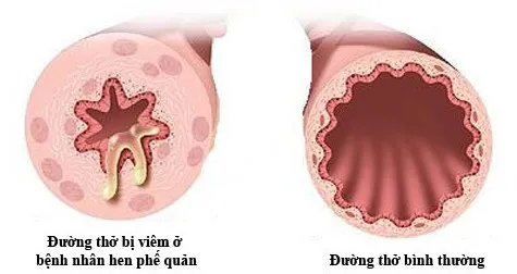 Hen phế quản là bệnh viêm mạn tính đường hô hấp.