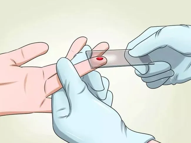 Để kiểm tra xem máu của bạn có mang ký sinh trùng gây sốt rét hay không, bác sĩ sẽ lấy mẫu máu và phân tích trong phòng thí nghiệm.