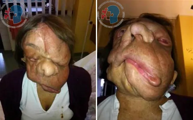 Khối u chèn lên mặt khiến Joanna không thể cử động được miệng.