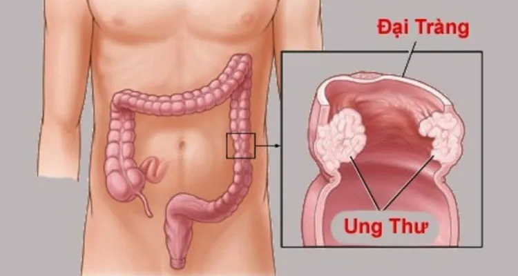 Bệnh ung thư trực tràng cũng rất dễ xảy ra ở lứa tuổi 20.