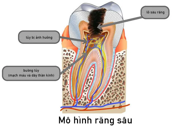 Mô hình răng sâu