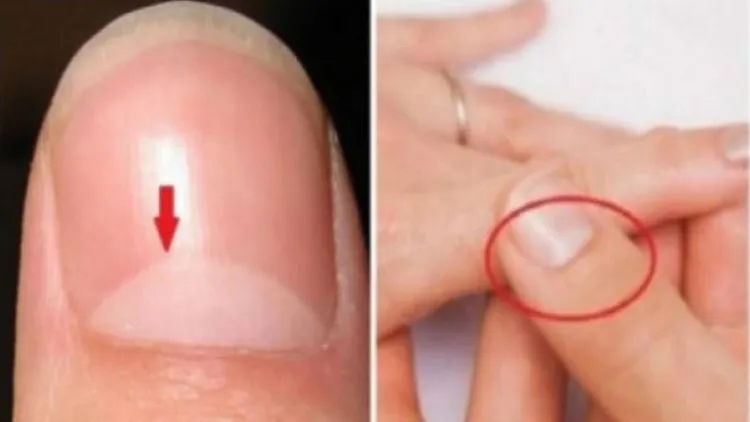 Ở người khỏe mạnh, móng tay có màu trắng hồng, bóng và luôn luôn có khuyết trắng ở gốc móng (khoảng 3mm).