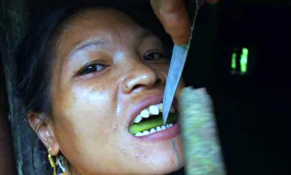 Miếng vỏ chuối là công cụ hỗ trợ "giảm đau" duy nhất mà họ sử dụng.