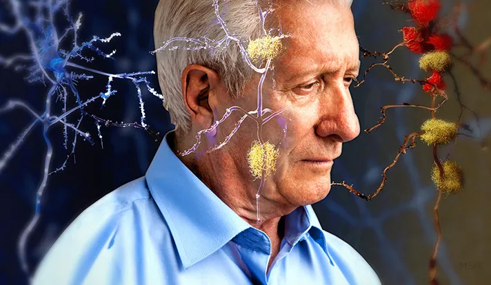 Hiện nay khoa học vẫn chưa hiểu rõ nguyên nhân và tiến triển của bệnh Alzheimer.
