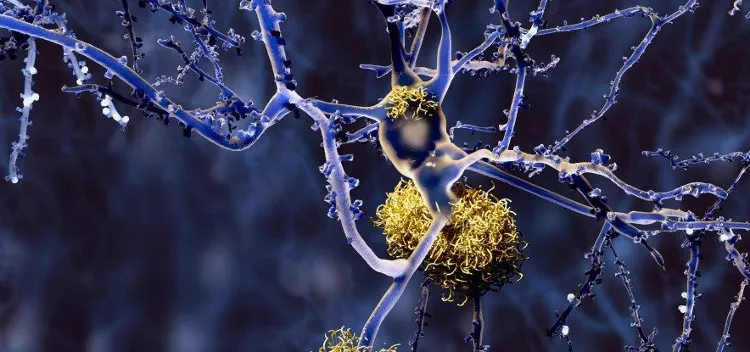 Những sợi protein bị rối loạn là nguyên nhân gây ra bệnh Alzheimer.