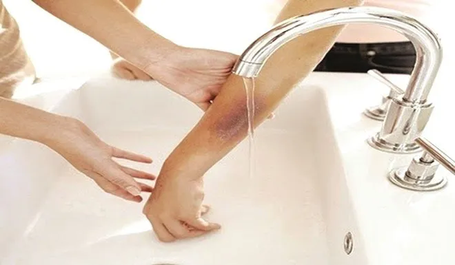 Ngoài tìm hiểu cách sơ cứu cơ bản, bạn nên mua thêm các loại thuốc trị bỏng đề phòng.