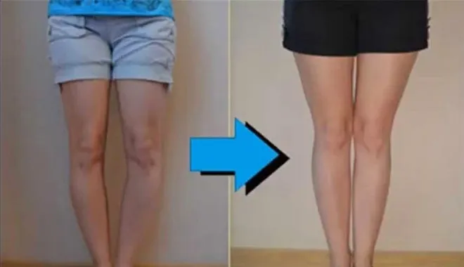 Ở người bị chân vòng kiềng 2 đầu gối chìa ra trong khi mắt cá chân chụm lại và bàn chân hướng thẳng về phía trước.