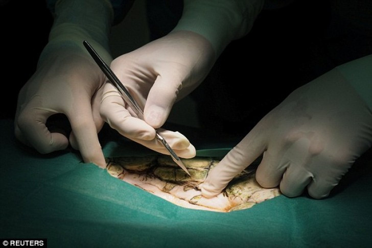 Ca mổ kéo dài 4 tiếng.