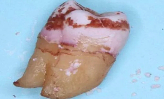 Bề mặt răng có nhiều đường nứt gãy.