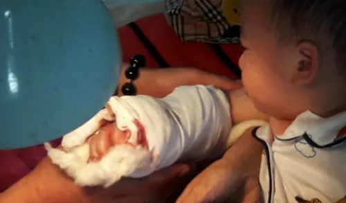 Bàn tay bé trai bì thang cuốn kẹp sau khi được bác sĩ phẫu thuật khâu nối.