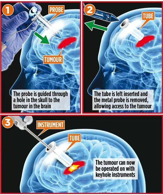 Sử dụng BrainPath, các bác sĩ phẫu thuật có thể loại bỏ khối u não mà không cần mở hộp sọ.