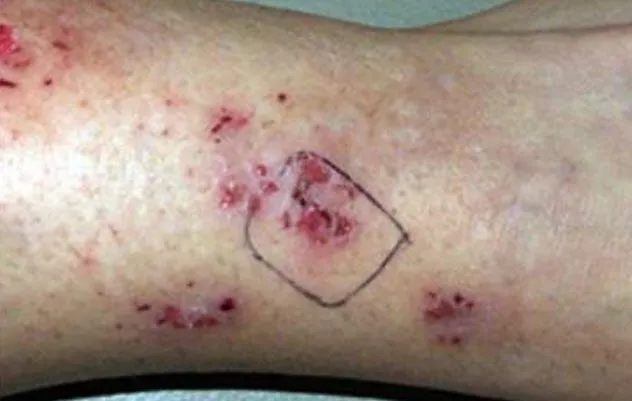 Bệnh Morgellons