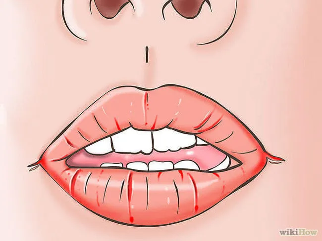 Chốc mép xảy ra là do nấm và vi khuẩn từ nước bọt bị kẹt lại khoé miệng quá lâu.