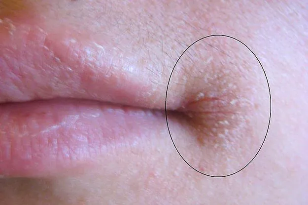 Hai bên khóe miệng của người trong bức hình có nhiều vết nứt toác.