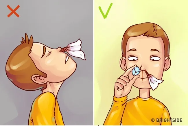 Khi chảy máu cam, bạn nên giữ đầu thẳng để máu chảy xuôi xuống, chườm lạnh ngăn máu chảy nhiều.