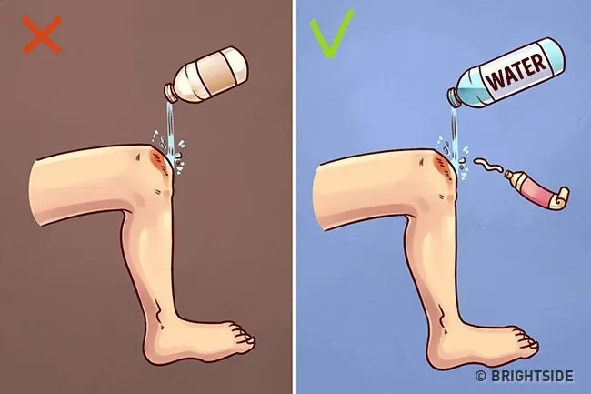 Rửa vết thương đúng cách là rửa bằng nước sạch hoặc nước đun sôi, rồi bôi thuốc mỡ lên vết thương.